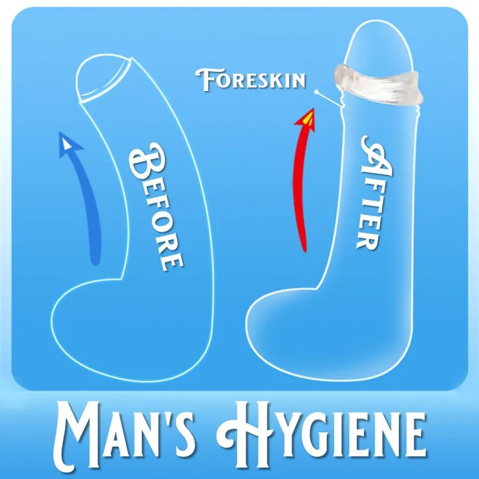 Male Sex Toys FRISKY BUSINESS SG Cock CRing Foreskin Correction Device